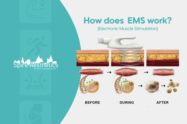 EMS treatment for post pregnancy weight loss treatment Oxfordshire