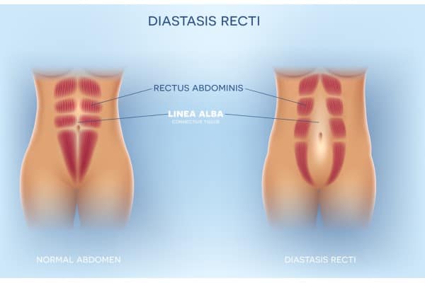 What Non-Surgical Options Are Available for Diastasis Recti Oxfordshire?