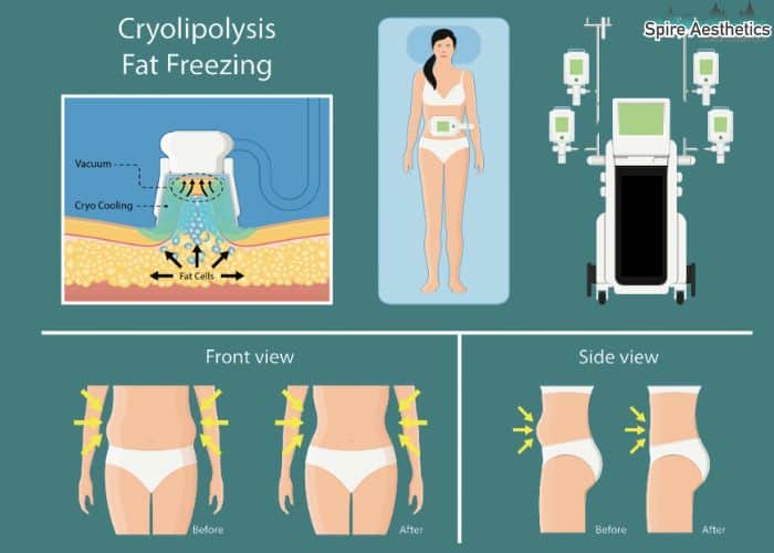Image of diet and fat freezing combined for best results for Spire Aesthetics Oxfordshire