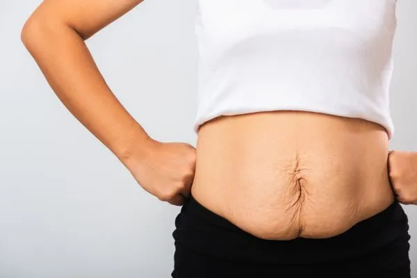 Image of a woman's stomach after weight loss with sagging skin following a gastric band Oxfordshire