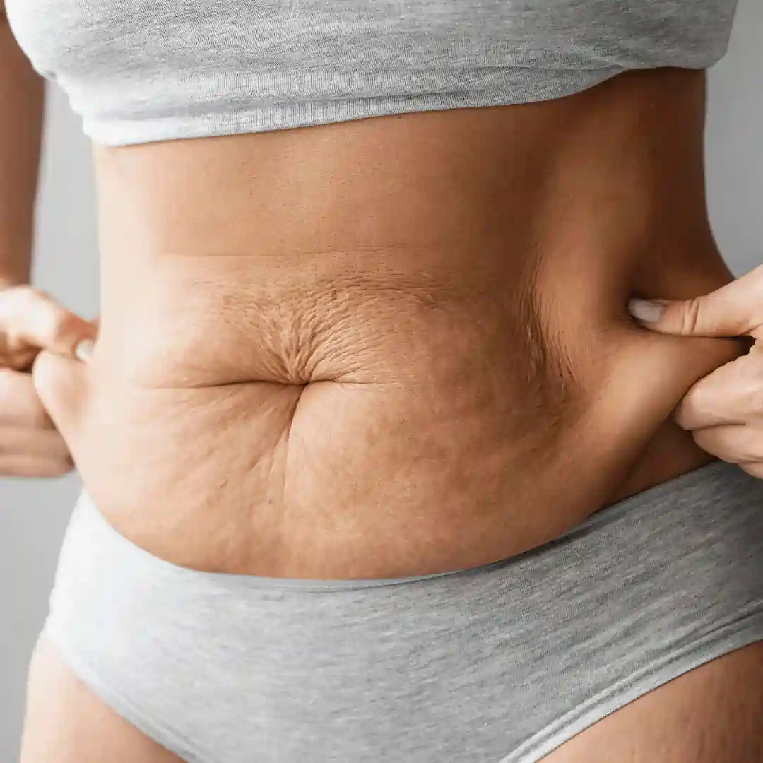 Is It Normal to Have Loose Skin After Pregnancy Oxfordshire?