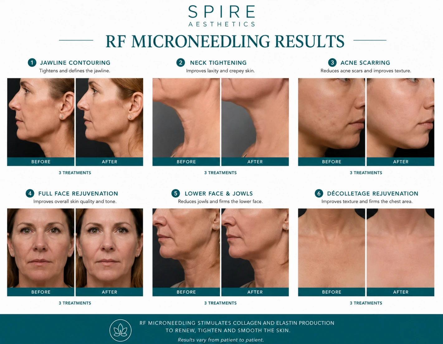 RF Microneedling Skin tightening Oxfordshire results