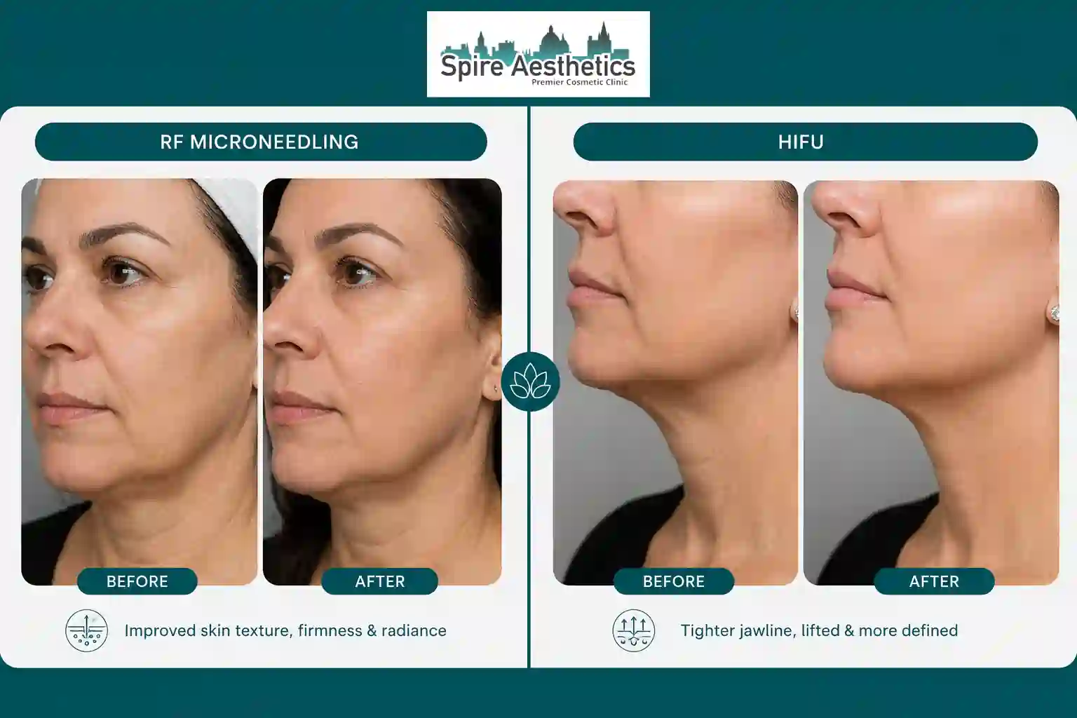 Can RF Microneedling and HIFU Be Combined Oxfordshire?
