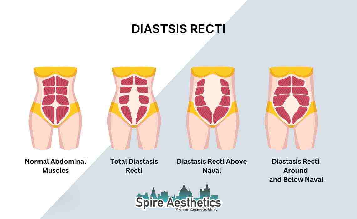 Is Non-Surgical Diastasis Recti Treatment Right for You? Common Concerns Answered Oxfordshire